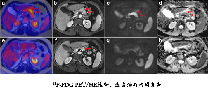影像PPT - 自身免疫性胰腺炎的影像学表现-15 影像PPT - 自身免疫性胰腺炎的影像学表现-15