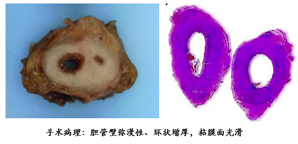 影像PPT - 自身免疫性胰腺炎的影像学表现-16 影像PPT - 自身免疫性胰腺炎的影像学表现-16