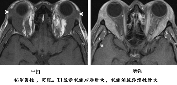 影像PPT - 自身免疫性胰腺炎的影像学表现-21 影像PPT - 自身免疫性胰腺炎的影像学表现-21