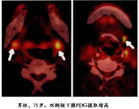 影像PPT - 自身免疫性胰腺炎的影像学表现-23 影像PPT - 自身免疫性胰腺炎的影像学表现-23