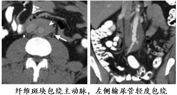影像PPT - 自身免疫性胰腺炎的影像学表现-25 影像PPT - 自身免疫性胰腺炎的影像学表现-25