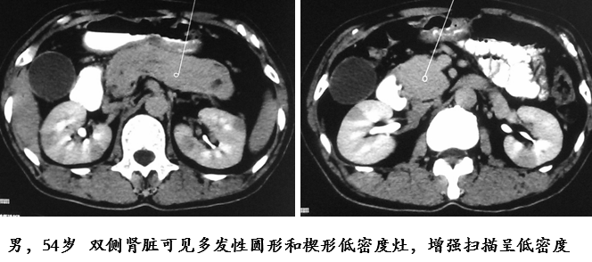 影像PPT - 自身免疫性胰腺炎的影像学表现-27 影像PPT - 自身免疫性胰腺炎的影像学表现-27