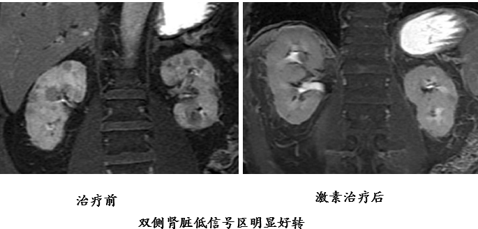 影像PPT - 自身免疫性胰腺炎的影像学表现-29 影像PPT - 自身免疫性胰腺炎的影像学表现-29