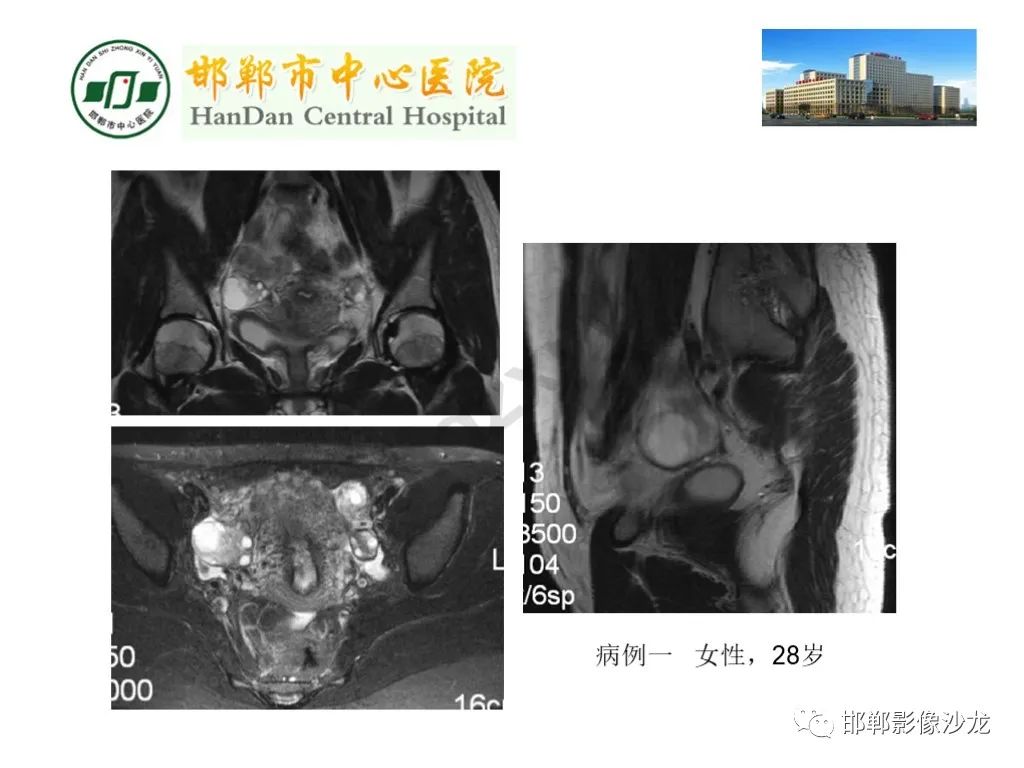 影像PPT - 【PPT】卵巢非肿瘤性病变的影像诊断-2