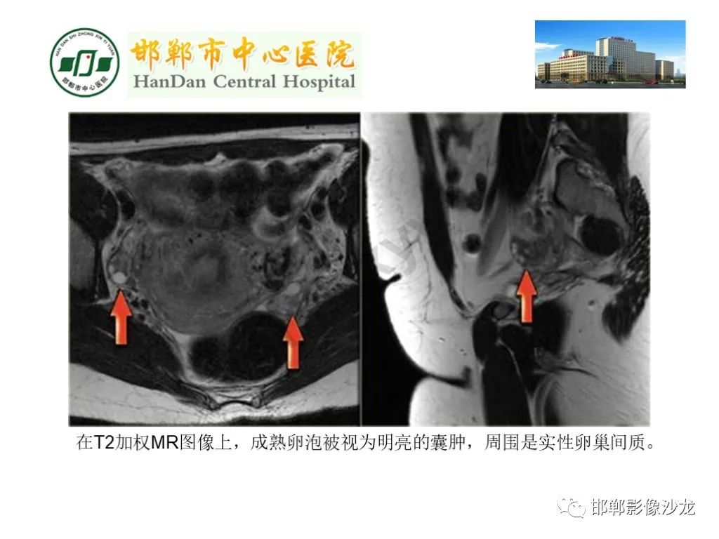 影像PPT - 【PPT】卵巢非肿瘤性病变的影像诊断-8