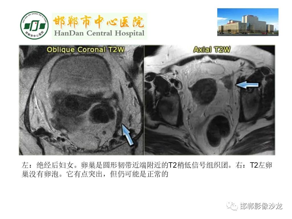 影像PPT - 【PPT】卵巢非肿瘤性病变的影像诊断-10