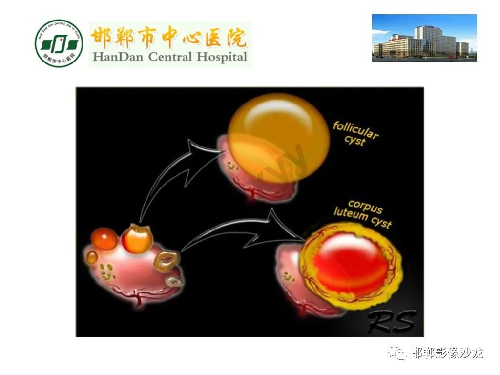 影像PPT - 【PPT】卵巢非肿瘤性病变的影像诊断-12