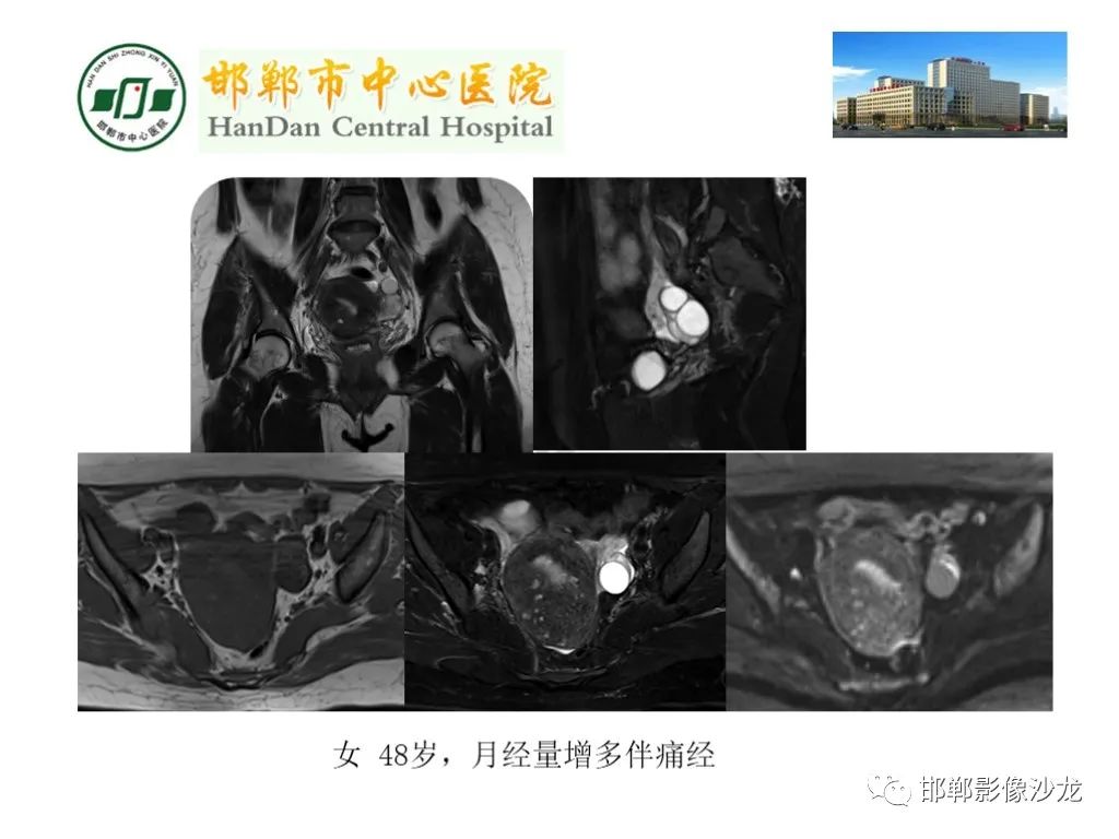 影像PPT - 【PPT】卵巢非肿瘤性病变的影像诊断-14