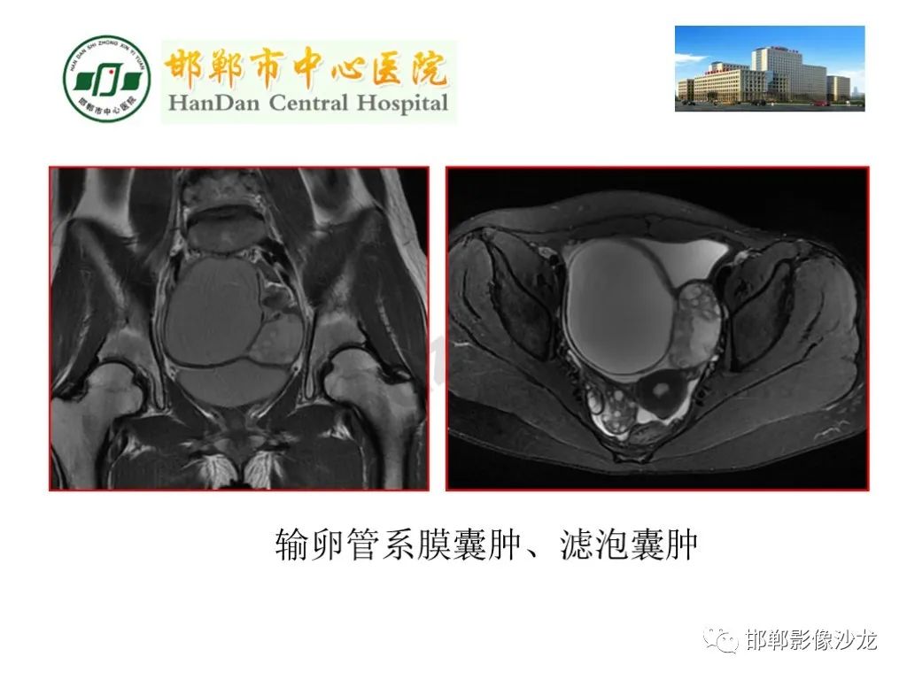 影像PPT - 【PPT】卵巢非肿瘤性病变的影像诊断-15