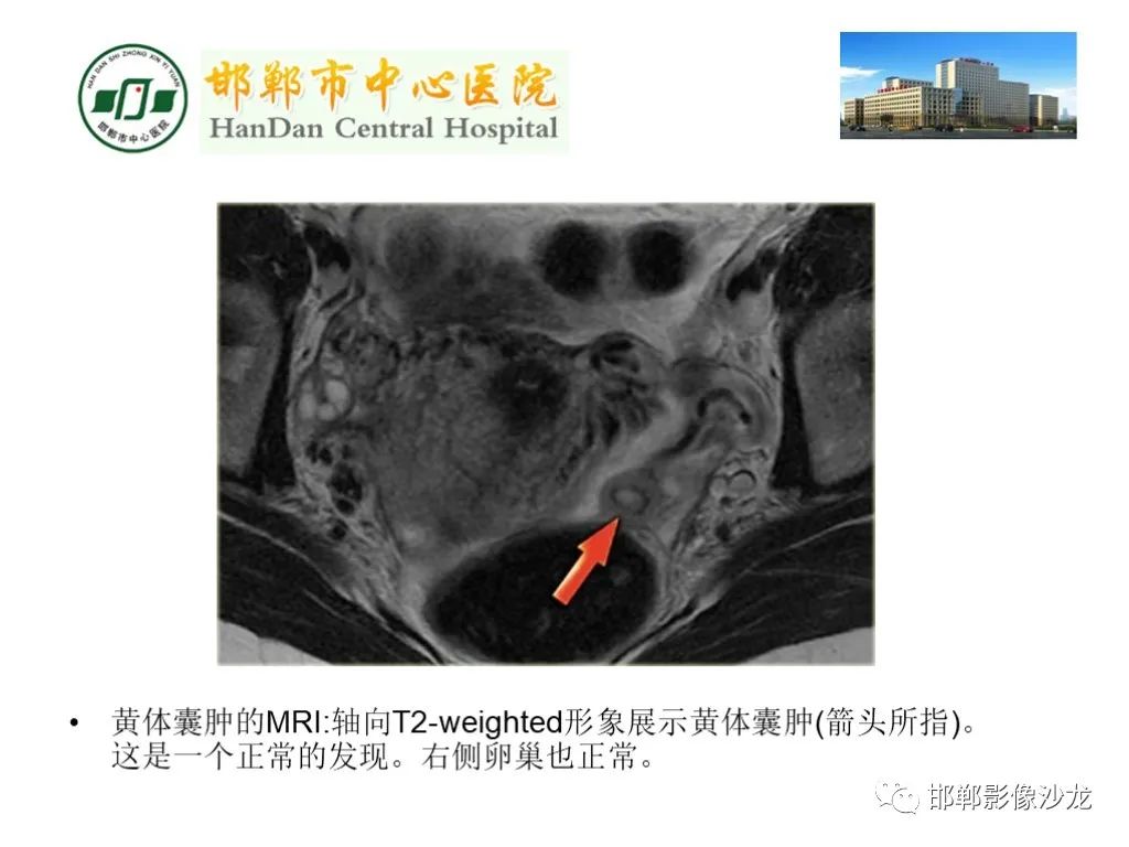 影像PPT - 【PPT】卵巢非肿瘤性病变的影像诊断-17