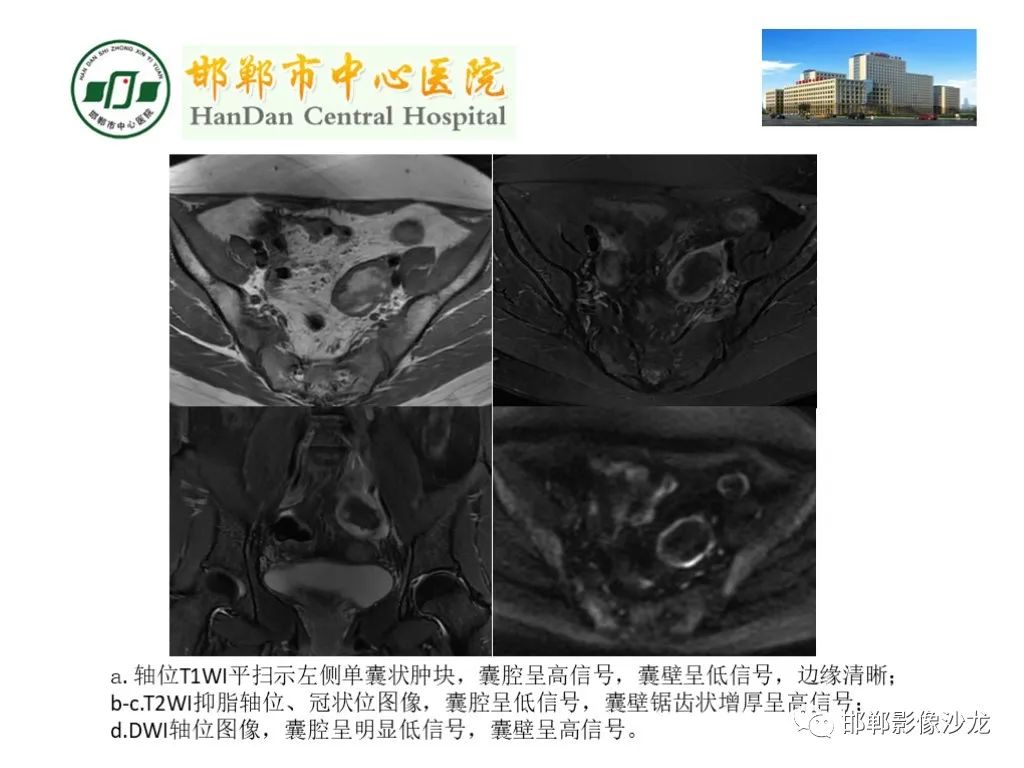 影像PPT - 【PPT】卵巢非肿瘤性病变的影像诊断-18