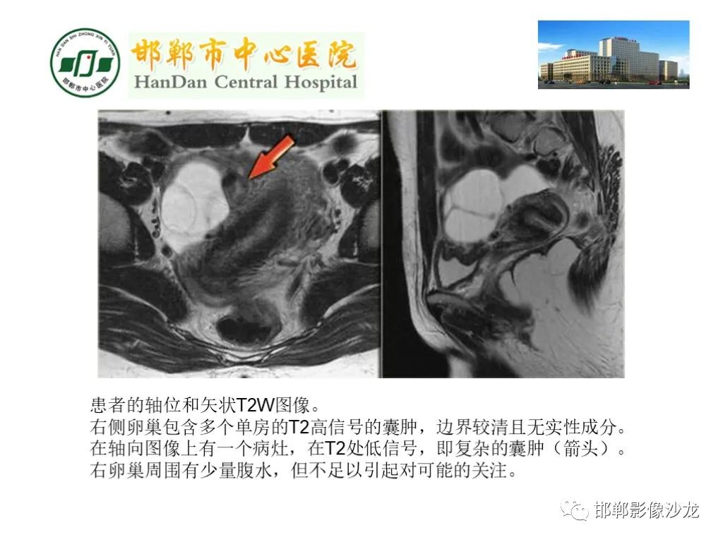 影像PPT - 【PPT】卵巢非肿瘤性病变的影像诊断-20