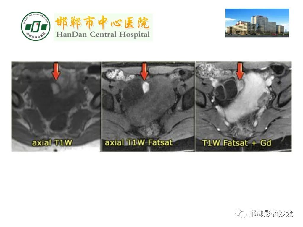 影像PPT - 【PPT】卵巢非肿瘤性病变的影像诊断-21