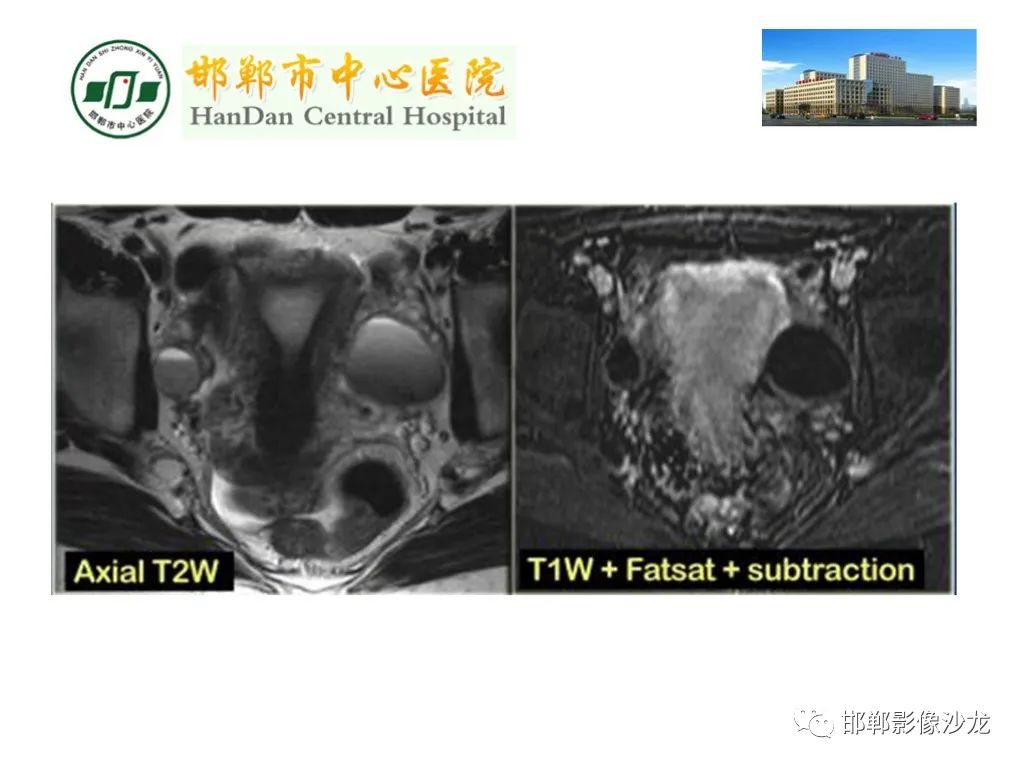 影像PPT - 【PPT】卵巢非肿瘤性病变的影像诊断-22