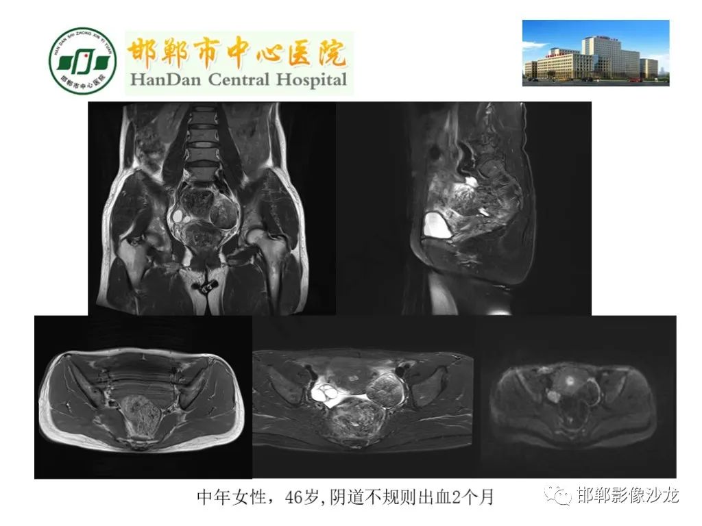 影像PPT - 【PPT】卵巢非肿瘤性病变的影像诊断-23
