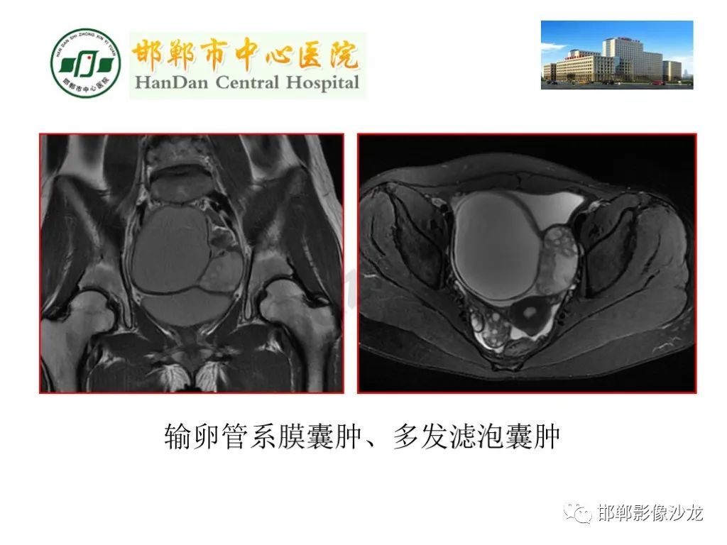 影像PPT - 【PPT】卵巢非肿瘤性病变的影像诊断-25