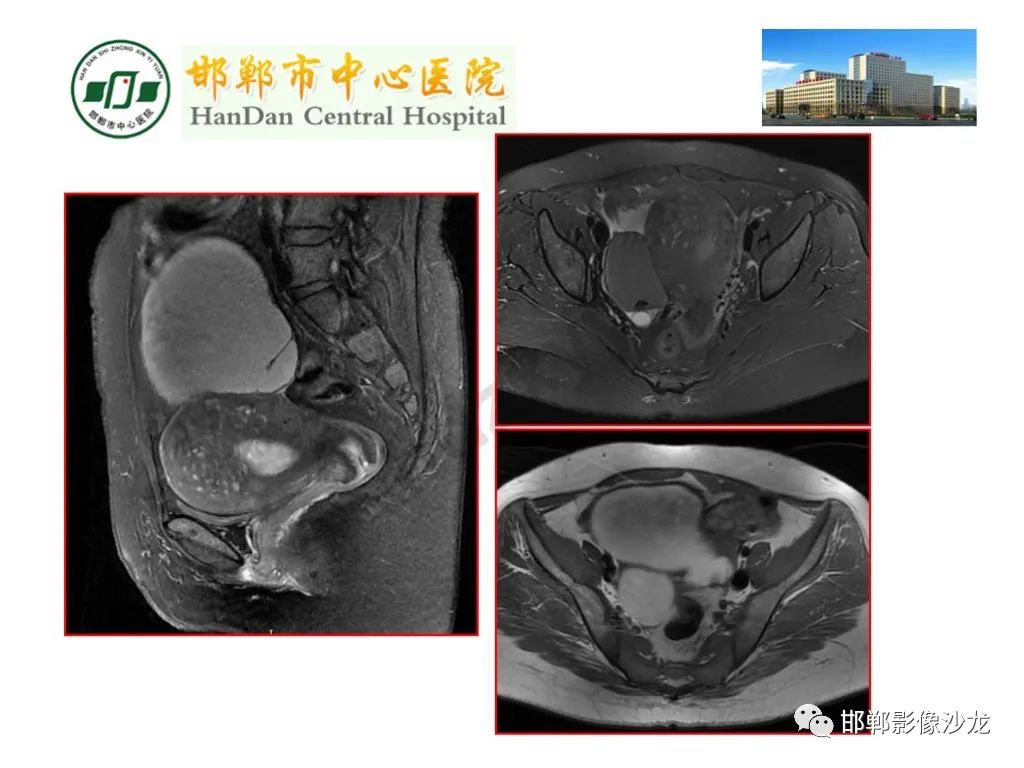 影像PPT - 【PPT】卵巢非肿瘤性病变的影像诊断-27