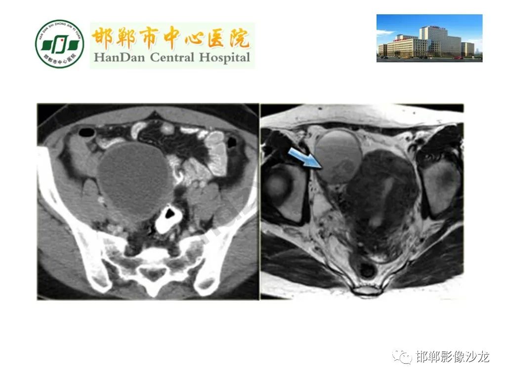 影像PPT - 【PPT】卵巢非肿瘤性病变的影像诊断-28