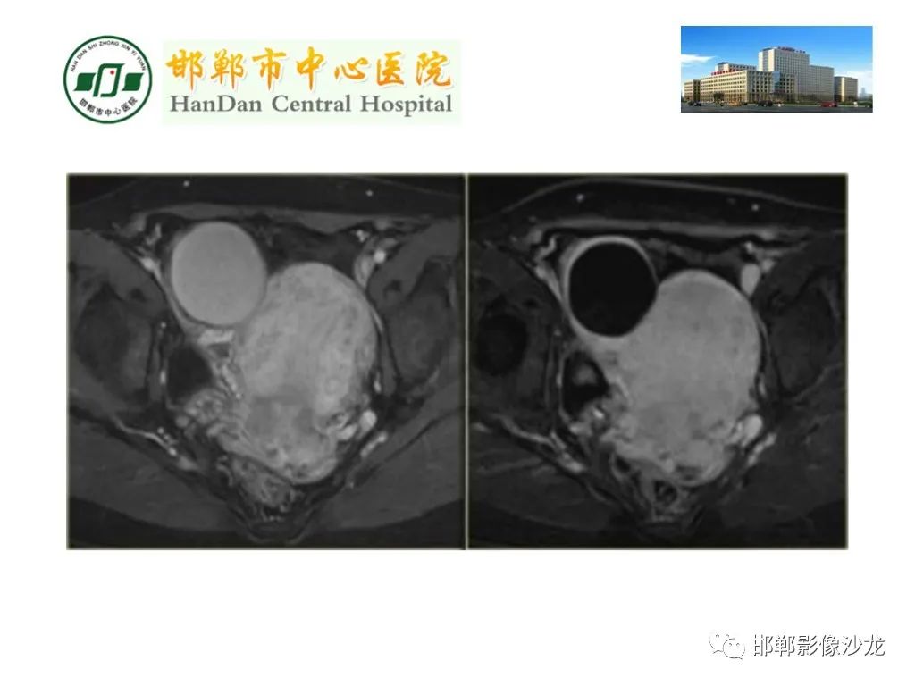 影像PPT - 【PPT】卵巢非肿瘤性病变的影像诊断-29