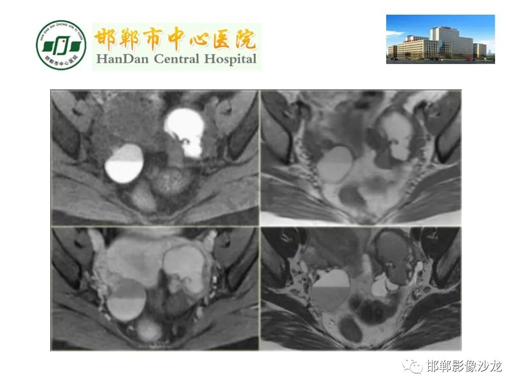 影像PPT - 【PPT】卵巢非肿瘤性病变的影像诊断-30