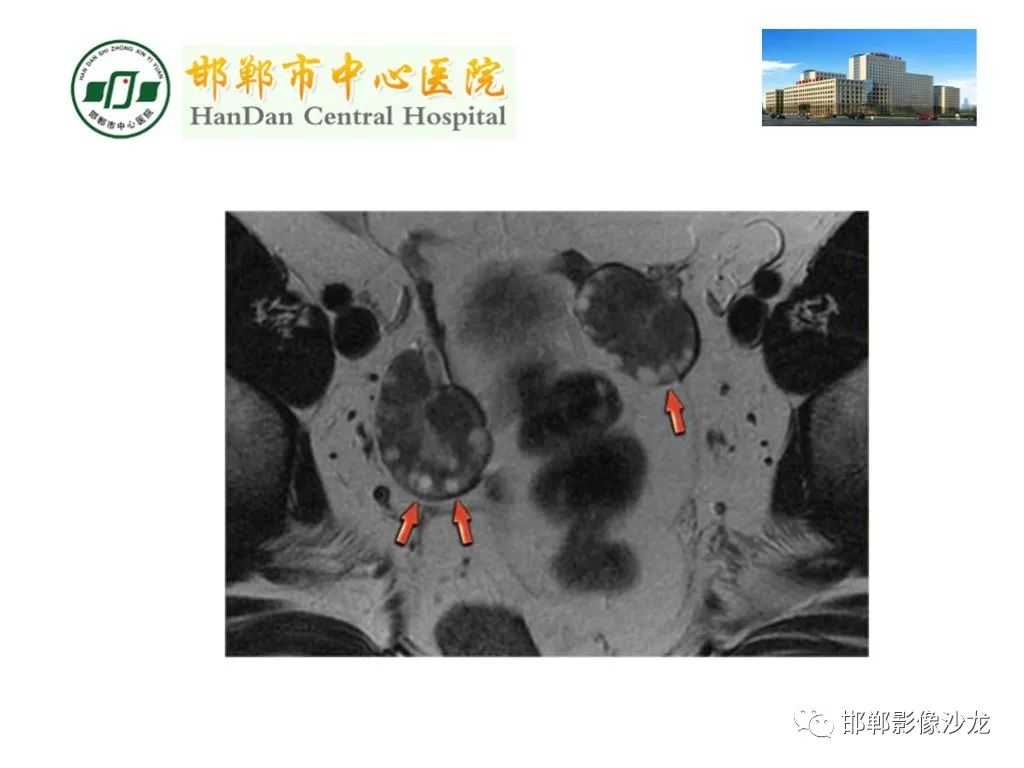 影像PPT - 【PPT】卵巢非肿瘤性病变的影像诊断-32