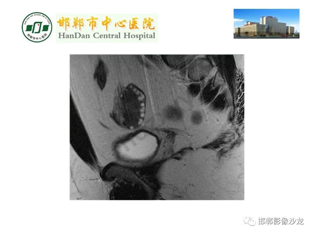 影像PPT - 【PPT】卵巢非肿瘤性病变的影像诊断-33