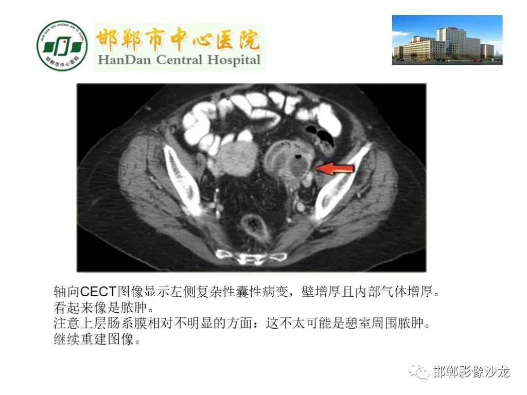 影像PPT - 【PPT】卵巢非肿瘤性病变的影像诊断-35