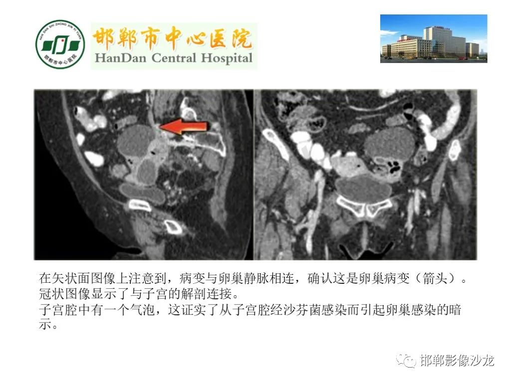 影像PPT - 【PPT】卵巢非肿瘤性病变的影像诊断-36
