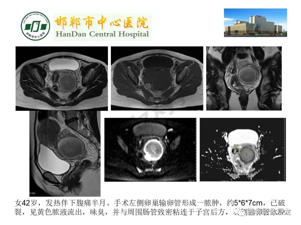 影像PPT - 【PPT】卵巢非肿瘤性病变的影像诊断-37