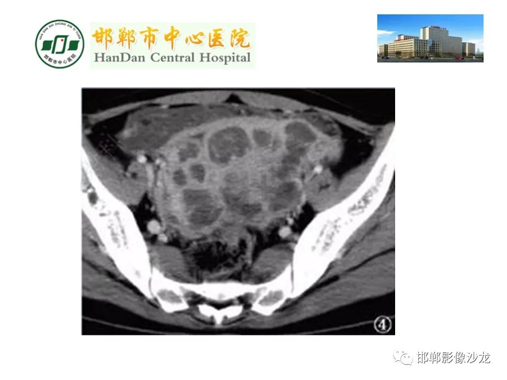 影像PPT - 【PPT】卵巢非肿瘤性病变的影像诊断-38