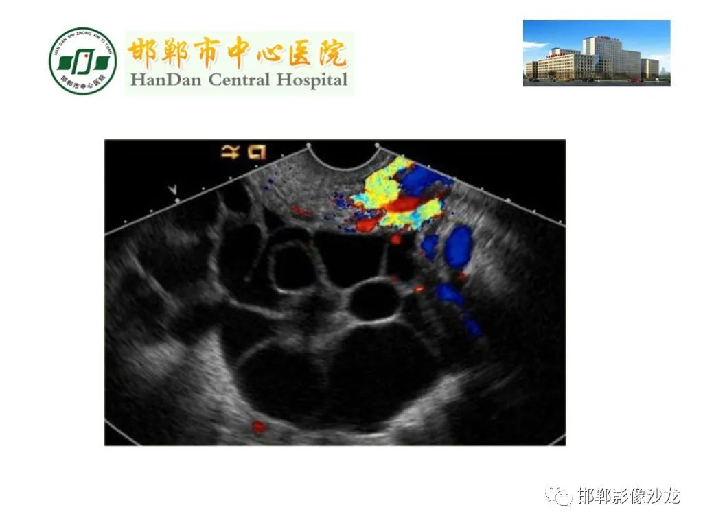 影像PPT - 【PPT】卵巢非肿瘤性病变的影像诊断-40