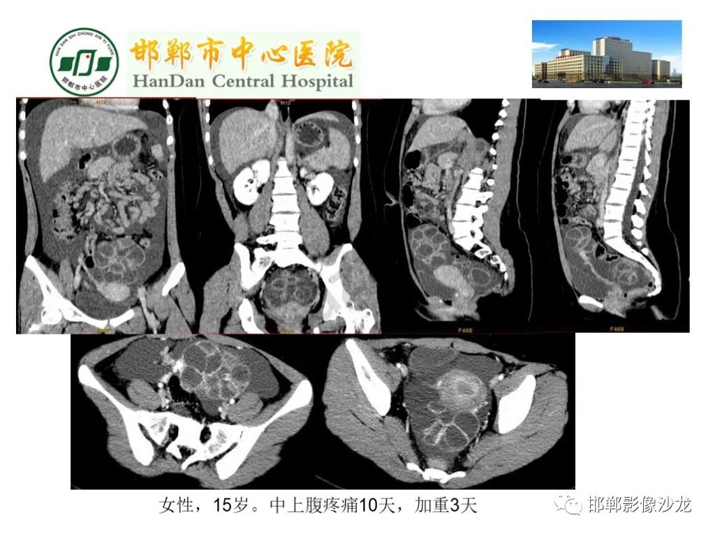 影像PPT - 【PPT】卵巢非肿瘤性病变的影像诊断-41