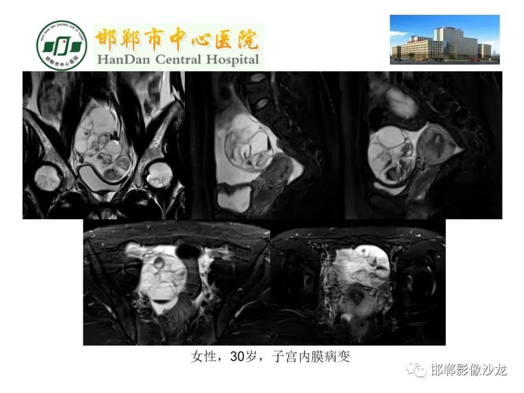影像PPT - 【PPT】卵巢非肿瘤性病变的影像诊断-43