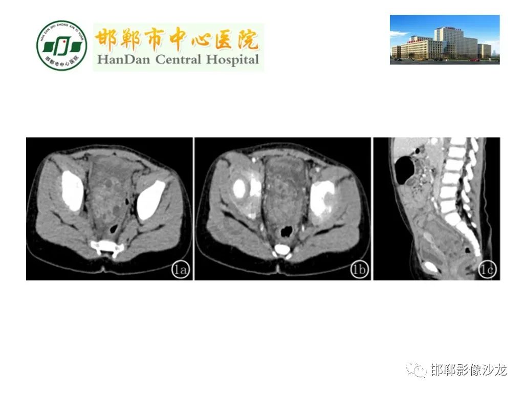 影像PPT - 【PPT】卵巢非肿瘤性病变的影像诊断-46