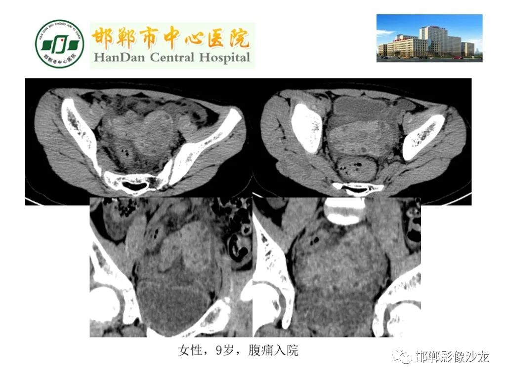 影像PPT - 【PPT】卵巢非肿瘤性病变的影像诊断-47