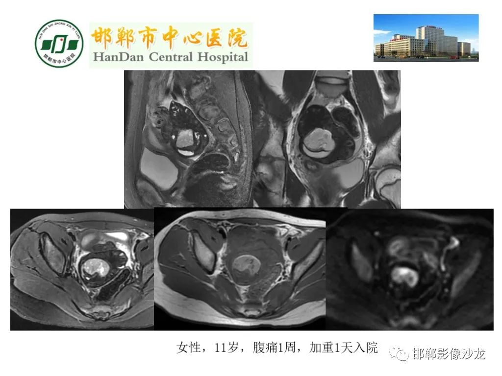 影像PPT - 【PPT】卵巢非肿瘤性病变的影像诊断-48