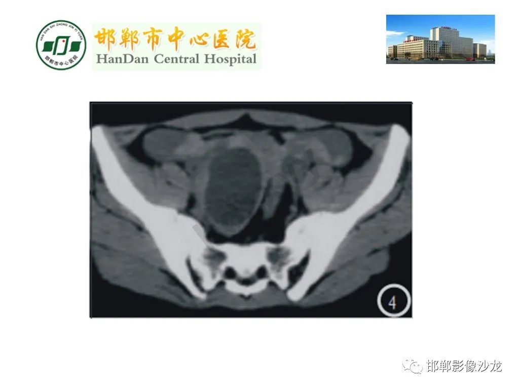 影像PPT - 【PPT】卵巢非肿瘤性病变的影像诊断-50