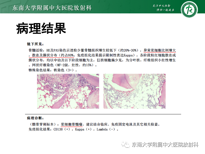 影像PPT - 【PPT】多发性骨髓瘤-3 影像PPT - 【PPT】多发性骨髓瘤-3