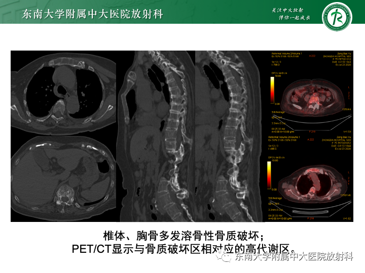 影像PPT - 【PPT】多发性骨髓瘤-4 影像PPT - 【PPT】多发性骨髓瘤-4