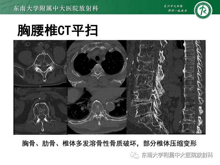 影像PPT - 【PPT】多发性骨髓瘤-1 影像PPT - 【PPT】多发性骨髓瘤-1
