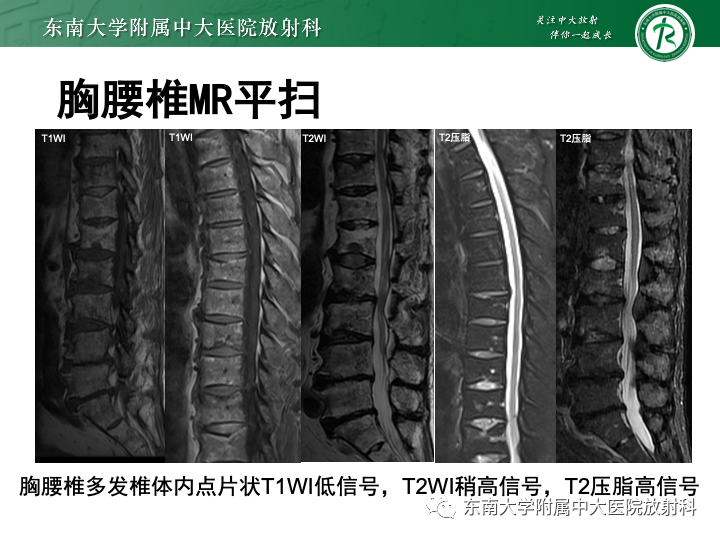 影像PPT - 【PPT】多发性骨髓瘤-2 影像PPT - 【PPT】多发性骨髓瘤-2