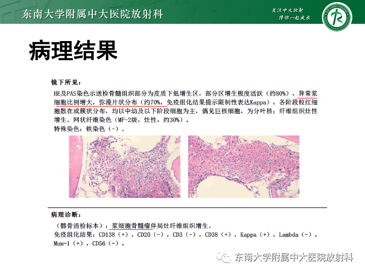 影像PPT - 【PPT】多发性骨髓瘤-5 影像PPT - 【PPT】多发性骨髓瘤-5