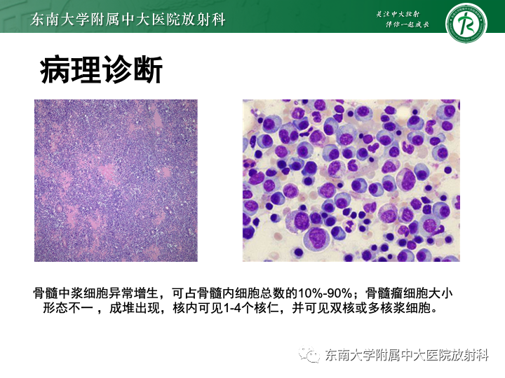 影像PPT - 【PPT】多发性骨髓瘤-15 影像PPT - 【PPT】多发性骨髓瘤-15