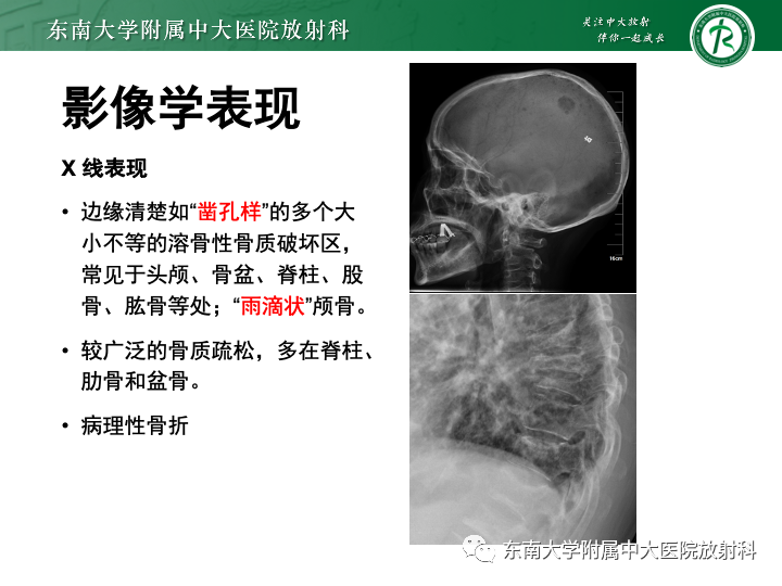 影像PPT - 【PPT】多发性骨髓瘤-18 影像PPT - 【PPT】多发性骨髓瘤-18