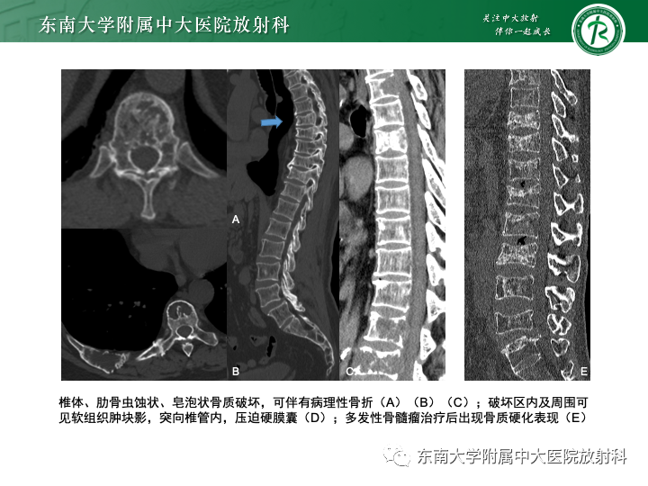 影像PPT - 【PPT】多发性骨髓瘤-20 影像PPT - 【PPT】多发性骨髓瘤-20