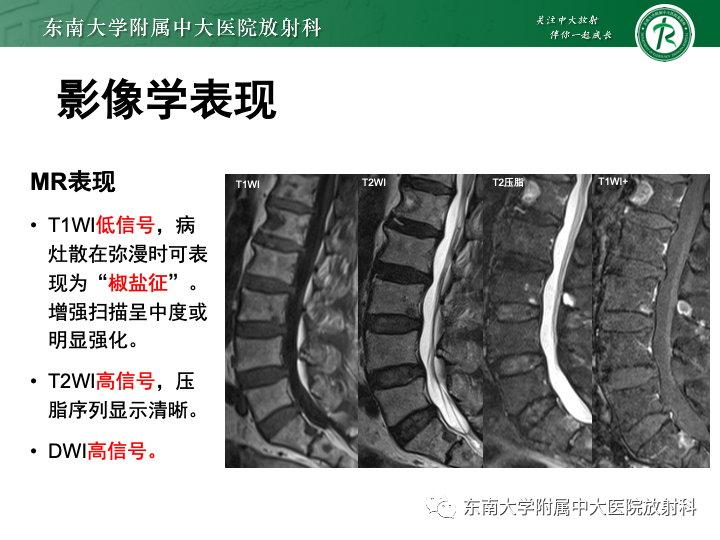 影像PPT - 【PPT】多发性骨髓瘤-21 影像PPT - 【PPT】多发性骨髓瘤-21
