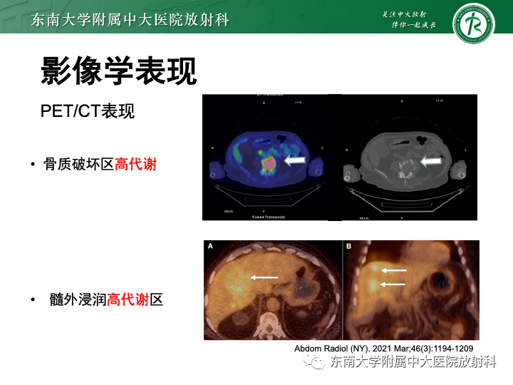影像PPT - 【PPT】多发性骨髓瘤-22 影像PPT - 【PPT】多发性骨髓瘤-22
