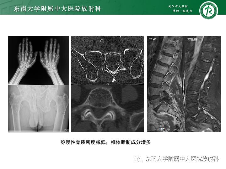 影像PPT - 【PPT】多发性骨髓瘤-25 影像PPT - 【PPT】多发性骨髓瘤-25