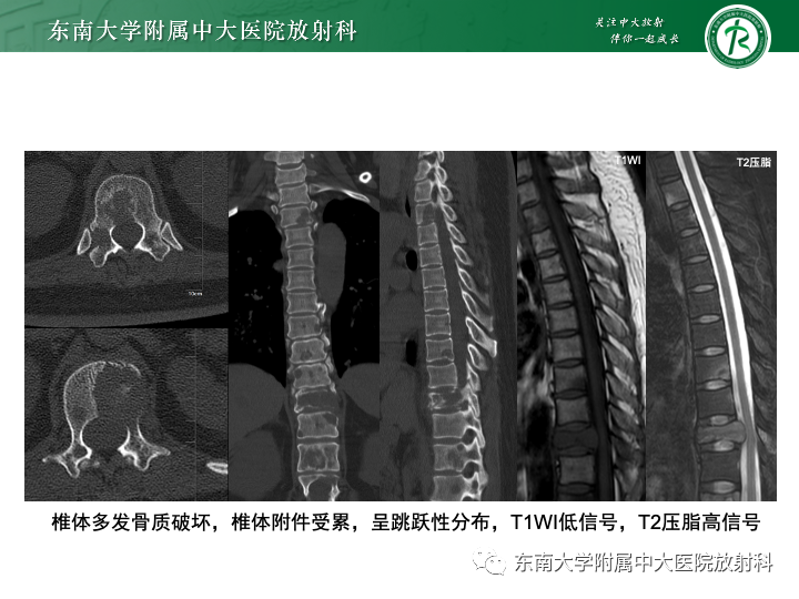 影像PPT - 【PPT】多发性骨髓瘤-28 影像PPT - 【PPT】多发性骨髓瘤-28