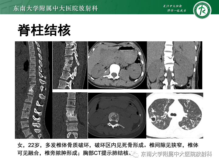 影像PPT - 【PPT】多发性骨髓瘤-31 影像PPT - 【PPT】多发性骨髓瘤-31